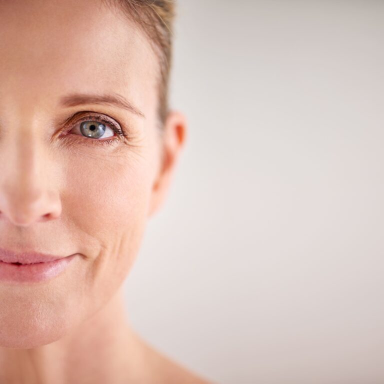 Imagen de una paciente de Ramon Medel de blefaroplastia superior vs blefaroplastia inferior
