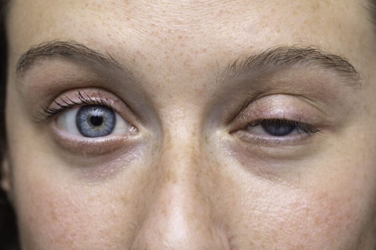 paciente de ramon medel en clinica medel eye hub para cirugia de ptosis palpebral con flap frontal